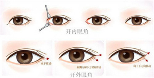 開內(nèi)眼角、外眼角 開內(nèi)眼角、外眼角