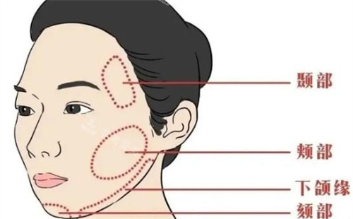面部提升可以提升的區(qū)域 面部提升可以提升的區(qū)域