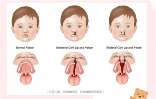 唇腭裂不同程度 唇腭裂不同程度