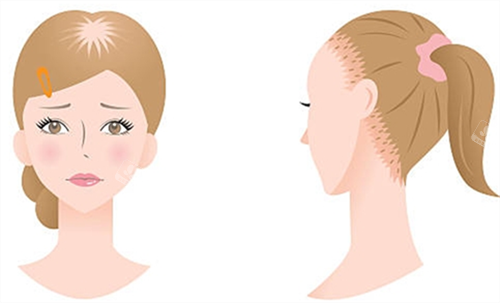 女生脱发类型