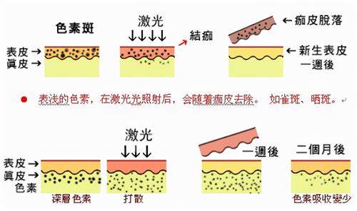 激光祛斑后的變化 激光祛斑后的變化