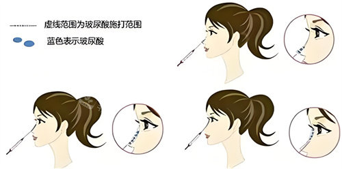 隆鼻玻尿酸部位圖 隆鼻玻尿酸部位圖