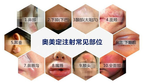 奥美定注射常见部位 奥美定注射常见部位
