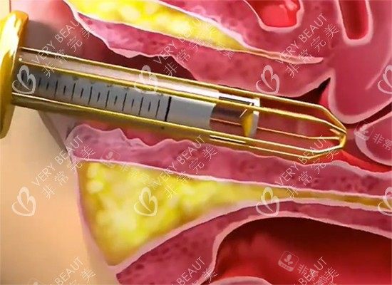 注射紧缩针图示 注射紧缩针图示