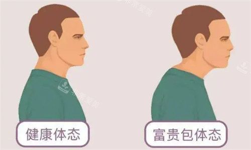 南昌富贵包哪家医院看的好?南昌治疗富贵包大概多少钱?