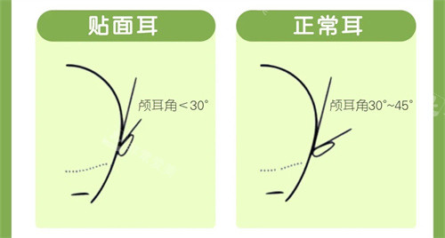 贴面耳与正常耳颅耳角对比图 贴面耳与正常耳颅耳角对比图