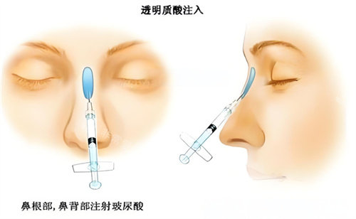 隆鼻玻尿酸注射圖 隆鼻玻尿酸注射圖