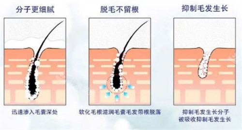 脫毛后毛囊的變化 脫毛后毛囊的變化