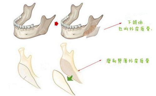 下頜角皮質(zhì)骨截骨手術(shù)圖片 下頜角皮質(zhì)骨截骨手術(shù)圖片