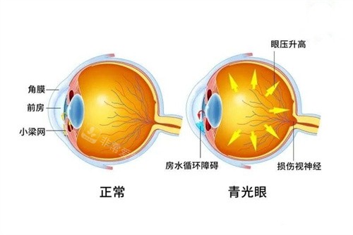 青光眼与正常眼对比图