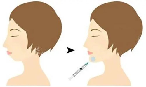 注射垫下巴前后的区别