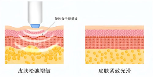 熱瑪吉作用對比 熱瑪吉作用對比