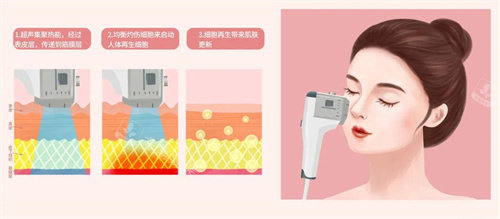 超声炮 超声炮