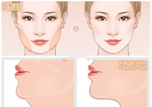 面部吸脂示意图 面部吸脂示意图
