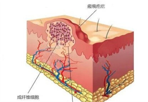 疤痕疙瘩怎么形成的 疤痕疙瘩怎么形成的