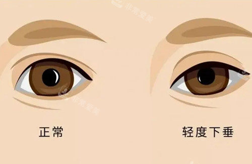 上睑轻度下垂和正常眼对比示意图 上睑轻度下垂和正常眼对比示意图