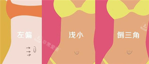 不同肚臍形態(tài) 不同肚臍形態(tài)