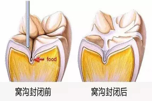 牙齿窝沟封闭前后对比卡通示意图