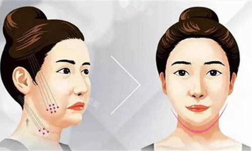 埋线提升卡通图 埋线提升卡通图