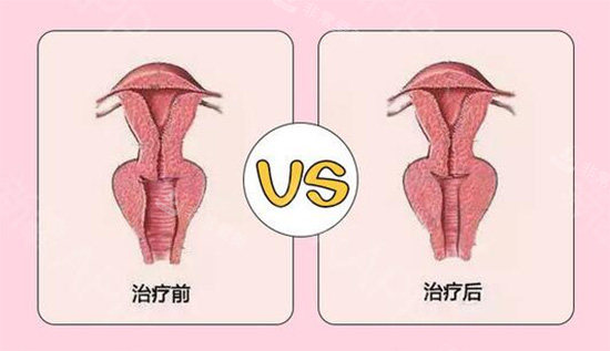 阴道紧缩针前后对比