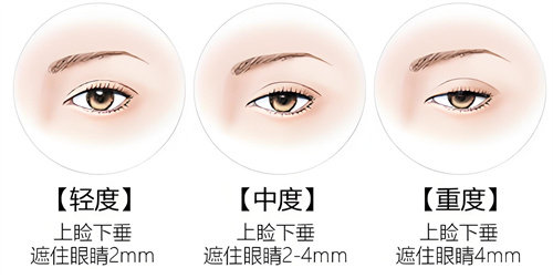 上睑下垂遮盖程度 上睑下垂遮盖程度