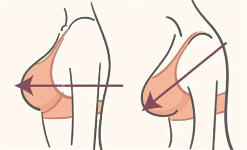 縮胸手術(shù)術(shù)前術(shù)后 縮胸手術(shù)術(shù)前術(shù)后