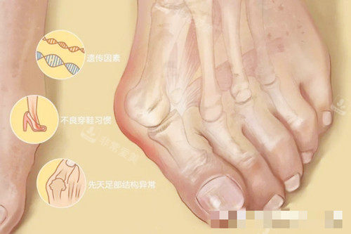 大腳骨圖示 大腳骨圖示