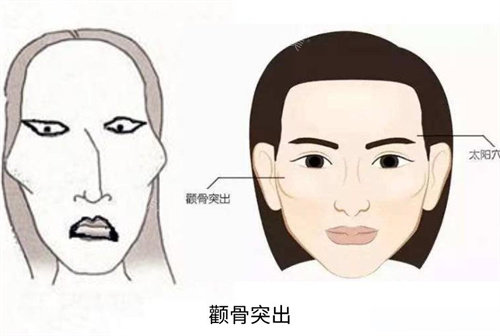 颧骨突出演示动画图 颧骨突出演示动画图