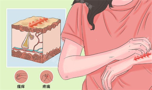 疤痕疙瘩的樣子 疤痕疙瘩的樣子