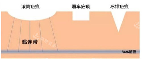 不同的疤痕種類 不同的疤痕種類