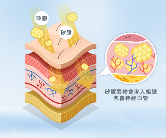 饅化針注射示意圖 饅化針注射示意圖