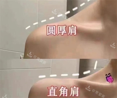 圓肩膀和直角肩對比 圓肩膀和直角肩對比