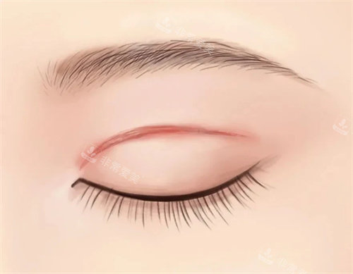 雙眼皮的術(shù)后疤痕 雙眼皮的術(shù)后疤痕