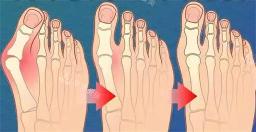 不同程度的大腳骨 不同程度的大腳骨