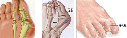 大腳骨的表現(xiàn) 大腳骨的表現(xiàn)