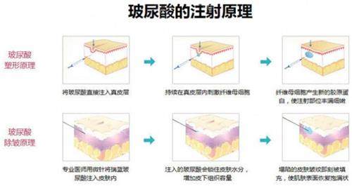 玻尿酸注射原理 玻尿酸注射原理
