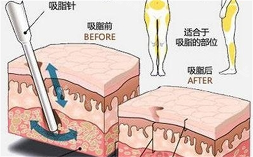 吸脂前后脂肪數(shù)量變化對比 吸脂前后脂肪數(shù)量變化對比