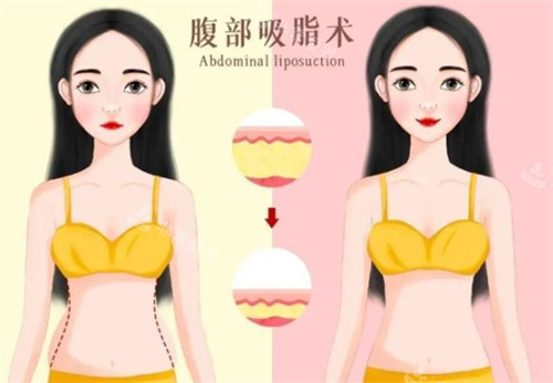 吸脂前后對比 吸脂前后對比