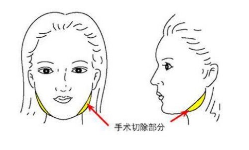 面部磨骨手术示意图 面部磨骨手术示意图