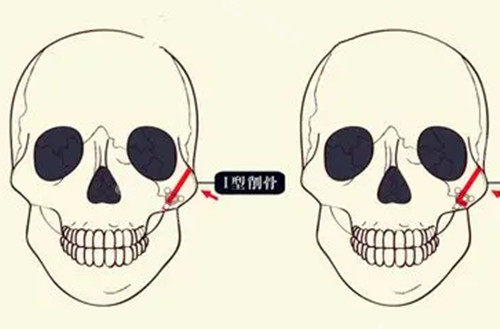 颧骨磨骨整形卡通示意图 颧骨磨骨整形卡通示意图