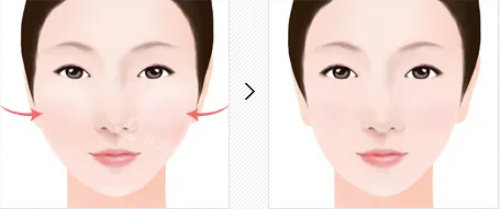 颧骨整形对比图 颧骨整形对比图