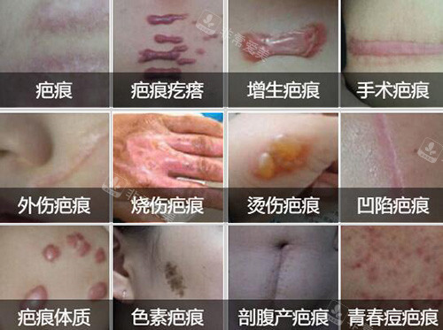 常见的疤痕类型展示图