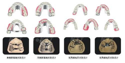 维他灵支架按照过程示意图