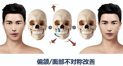 正頜手術(shù)原理與對(duì)比展示動(dòng)畫圖 正頜手術(shù)原理與對(duì)比展示動(dòng)畫圖