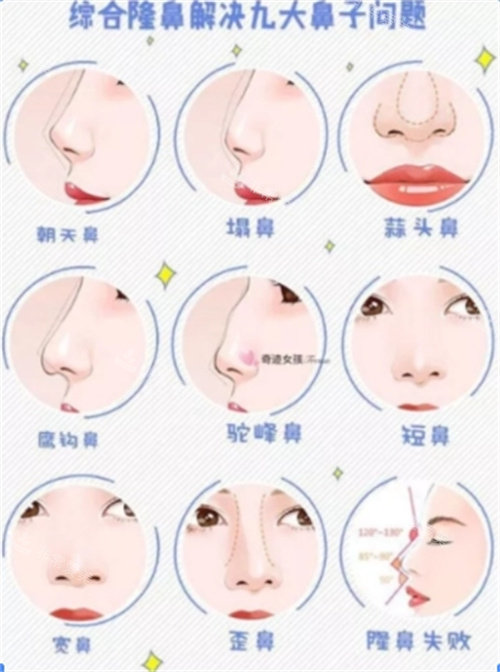 隆鼻 隆鼻