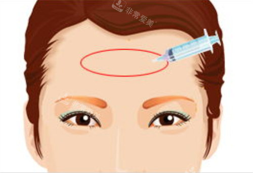 填充額頭術(shù)玻尿酸注射動畫圖 填充額頭術(shù)玻尿酸注射動畫圖