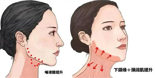 提升下颌线 提升下颌线