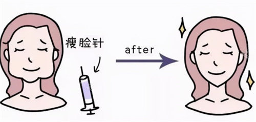 瘦臉注射前后卡通 瘦臉注射前后卡通