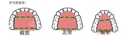 牙齿矫正牙弓形状