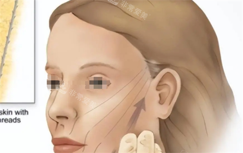 微拉美提升方向动画展示